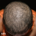 trichotillomania