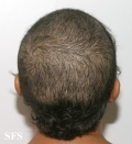 trichotillomania