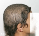 trichotillomania