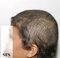 trichotillomania