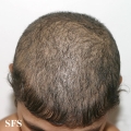 trichotillomania