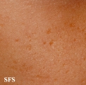atrophodermia vermiculata