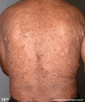 neurofibromatosis