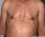 neurofibromatosis