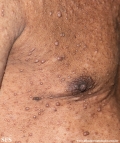 neurofibromatosis