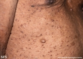 neurofibromatosis