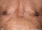 neurofibromatosis