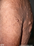 neurofibromatosis