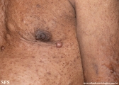 neurofibromatosis