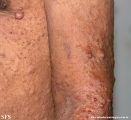 neurofibromatosis