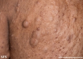 neurofibromatosis