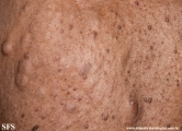 neurofibromatosis