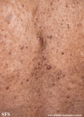 neurofibromatosis