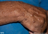 neurofibromatosis