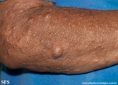 neurofibromatosis