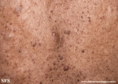 neurofibromatosis