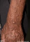 neurofibromatosis
