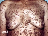 neurofibromatosis