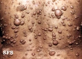 neurofibromatosis