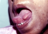 neurofibromatosis
