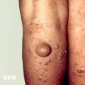 neurofibromatosis