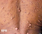 neurofibromatosis