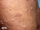 neurofibromatosis