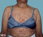 neurofibromatosis