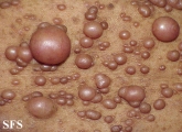 neurofibromatosis
