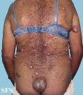 neurofibromatosis