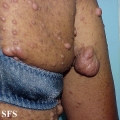 neurofibromatosis