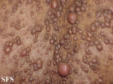 neurofibromatosis