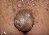 neurofibromatosis