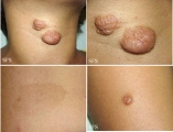 neurofibromatosis