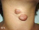 neurofibromatosis