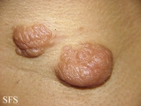 neurofibromatosis
