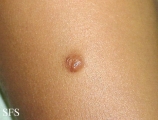 neurofibromatosis