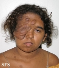 neurofibromatosis