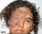 neurofibromatosis