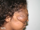 neurofibromatosis