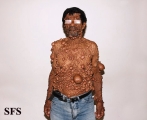neurofibromatosis