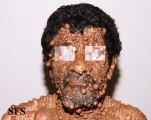 neurofibromatosis