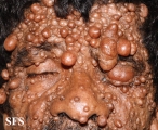 neurofibromatosis