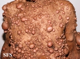 neurofibromatosis