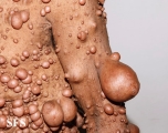 neurofibromatosis