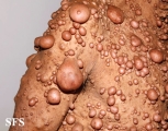 neurofibromatosis