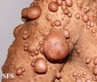 neurofibromatosis