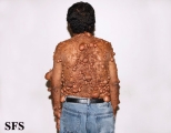 neurofibromatosis