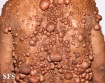 neurofibromatosis