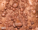 neurofibromatosis